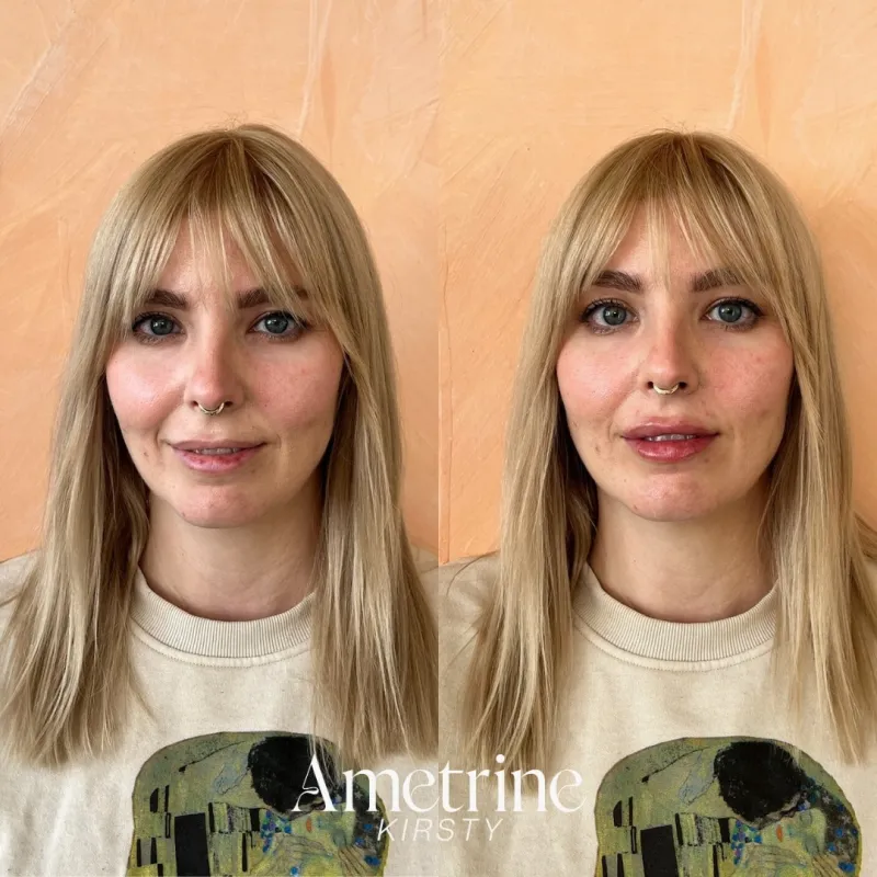 lip filler before and after part two