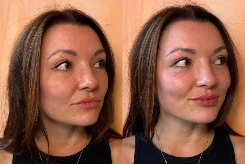 lip filler before and after newcastle