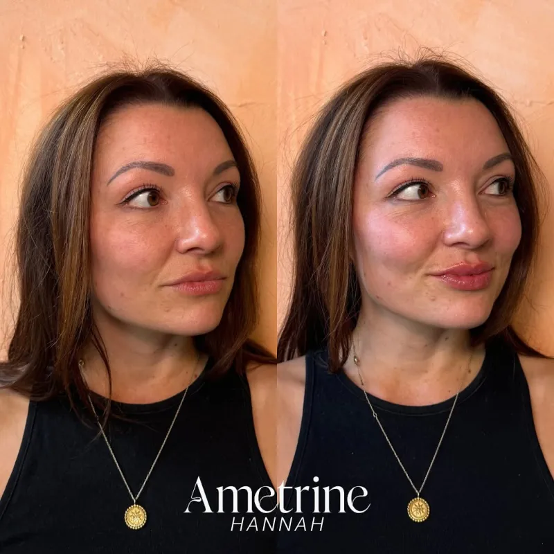 lip filler before and after newcastle