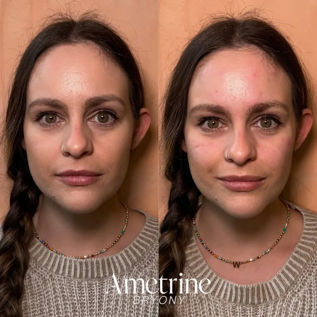 tear through filler before and after newcastle