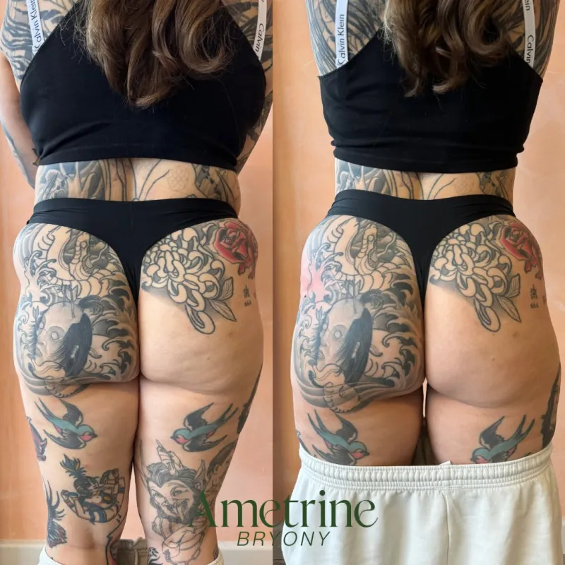 bum sculptra treatment before and after newcastle
