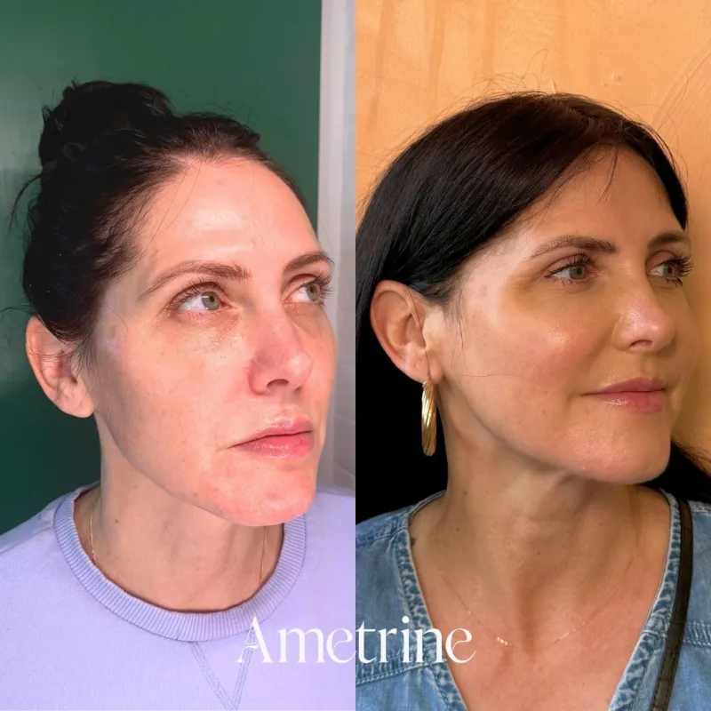 sculptra face treatment before and after