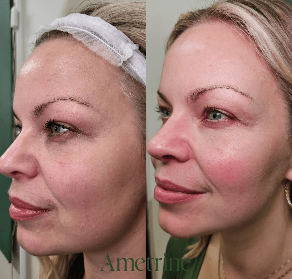 prp treatment before and after newcastle