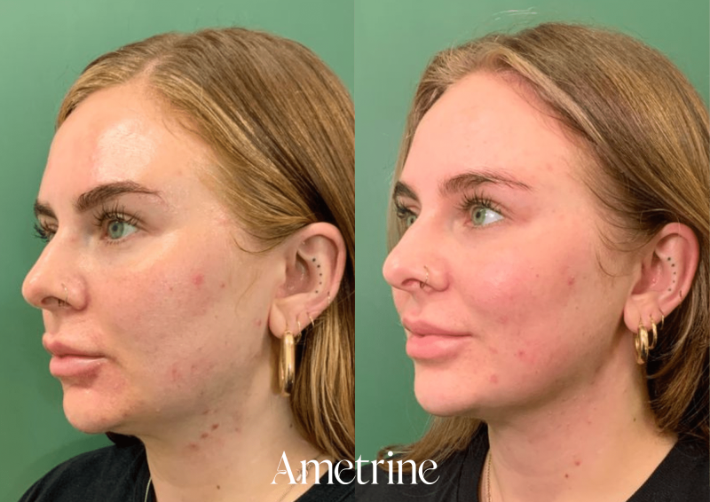 chemical peel before and after newcastle