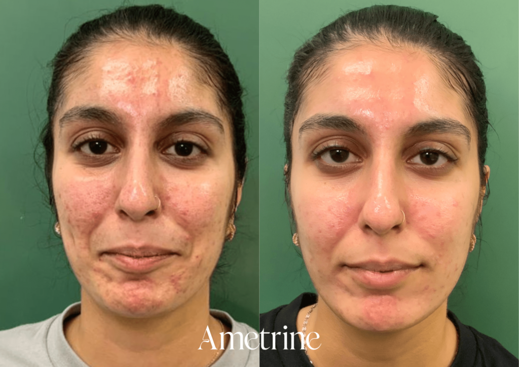microneedling before and after newcastle