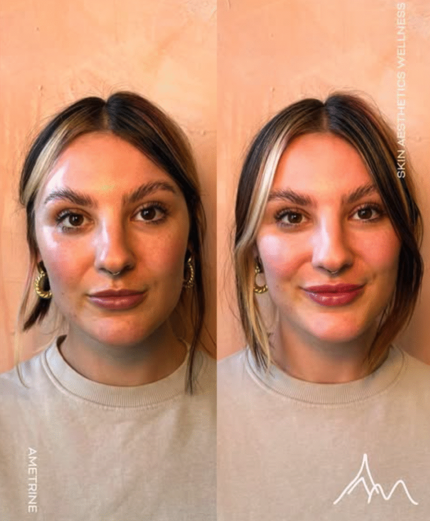 Natural lip filler before and after