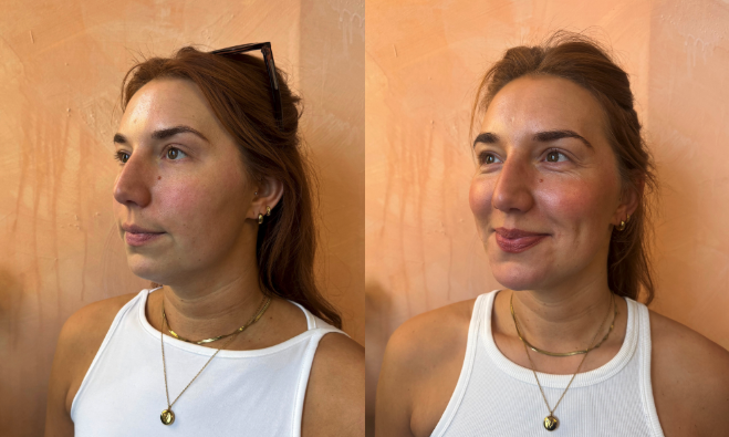 chin filler in newcastle