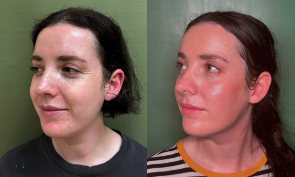 scupltra before and after treatment at our newcastle clinic