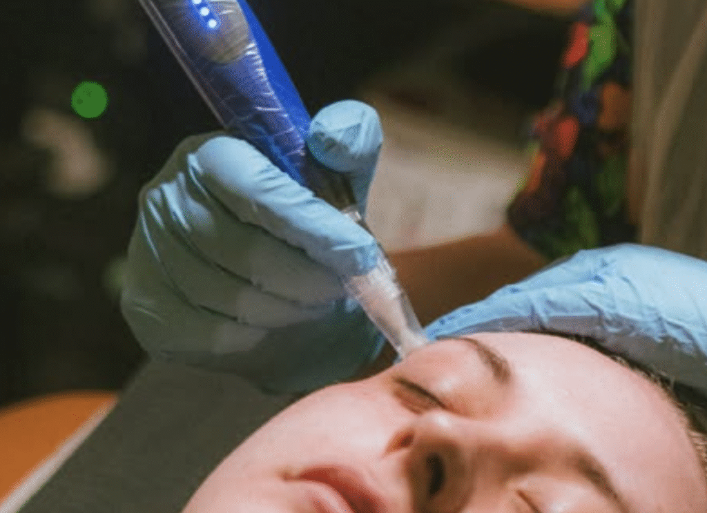 prp skinpen for hair treatment