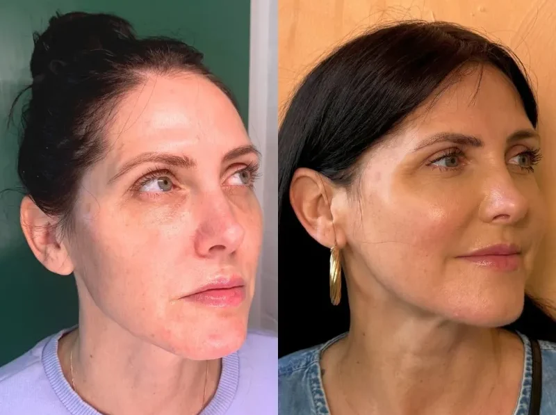 sculptra face treatment before and after